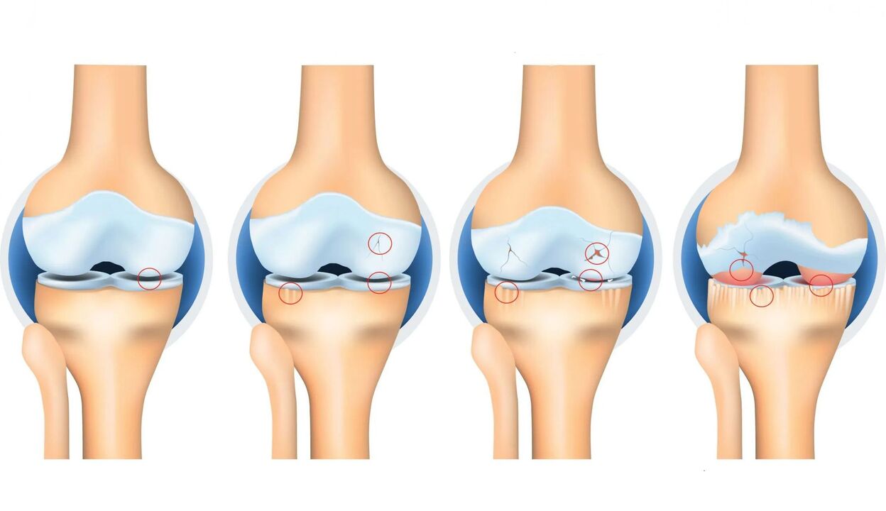 Arthrose des articulations